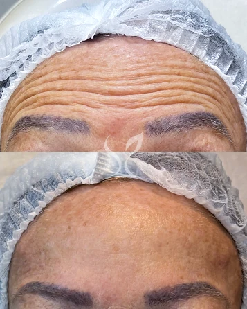 Botox
