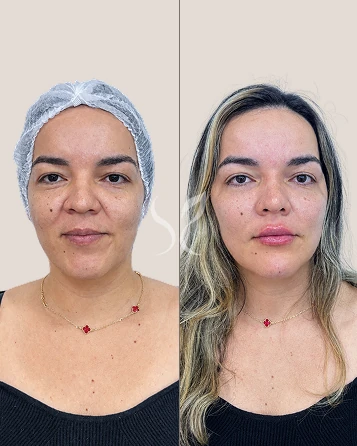 Harmonização Facial