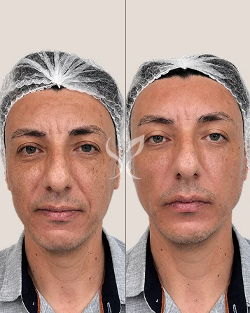Harmonização Facial